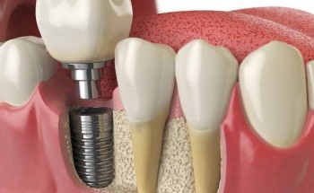 Implante dentário – Enxerto ósseo e técnicas cirúrgicas alternativas