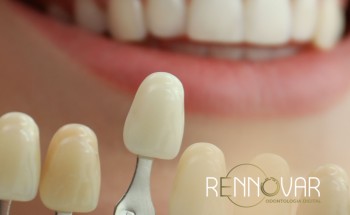 Lentes de Contato Dental: O Guia Definitivo para um Sorriso Perfeito.